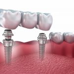 Выгодная акция на установку зубных имплантов запущена клиникой «Зууб.рф»