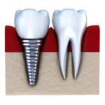 Применение имплантации позволяет восстановить утраченные зубы