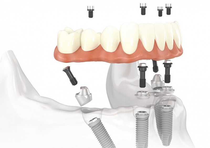 Протокол All-on-4: имплантация в стоматологическом центре «Зууб»