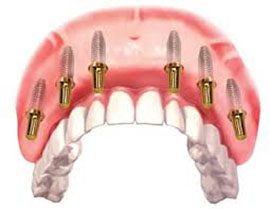 Стоматология «Зууб» ждет пациентов для восстановления зубов по протоколу «All-на 6»
